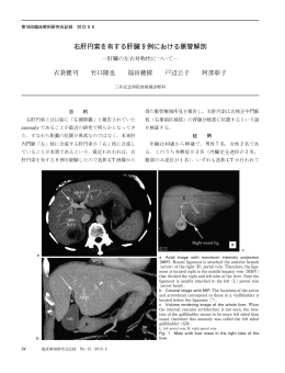 右肝円索を有する肝臓  例における脈管解剖