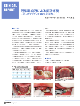 CLINICAL REPORT 既製乳歯冠による歯冠修復