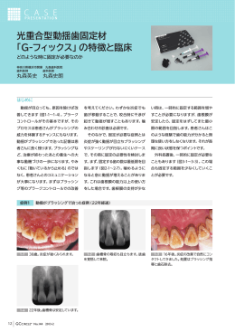 光重合型動揺歯固定材「G-フィックス」の特徴と臨床 どのよう