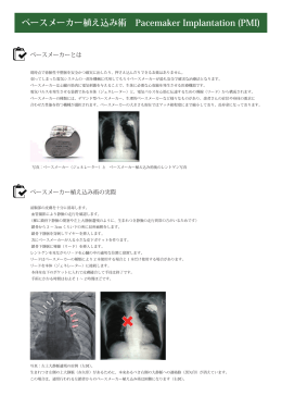 ペースメーカー植え込み術 Pacemaker Implantation (PMI)