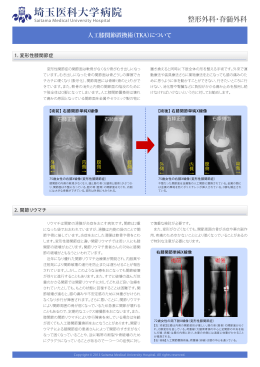 人工膝関節置換術（TKA）
