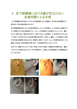 4 耳下腺腫瘍における傷が目立たない 皮膚切開による手術