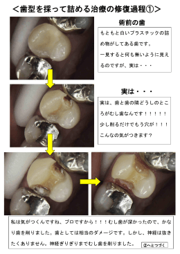 ＜歯型を採って詰める治療の修復過程①＞