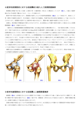変形性股関節症に対する低侵襲前方進入人工股関節置換術 変形性膝