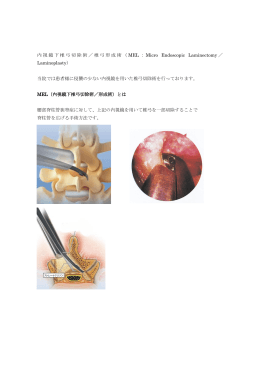 内視鏡下椎弓切除術／椎弓形成術（MEL：Micro Endoscopic