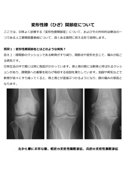 変形性膝（ひざ）関節症について
