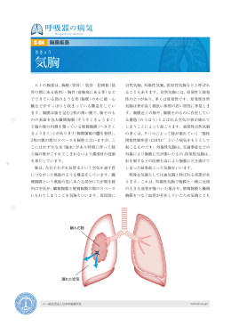気胸 - 日本呼吸器学会