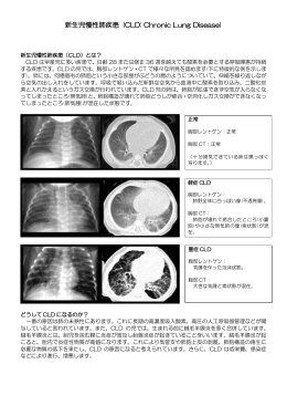新生児慢性肺疾患 (CLD: Chronic Lung Disease)