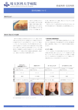 巻き爪 - 埼玉医科大学