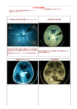 その他の脳腫瘍 下垂体鞍上部の胚芽腫（ジャーミノーマ） 松果体部の