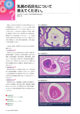 乳房の石灰化について 教えてください。 - nyugan.info 乳癌診療情報サイト