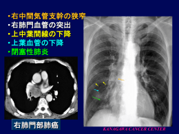 •右中間気管支幹の狭窄 •右肺門血管の突出 •上中葉間線の下降 •上葉