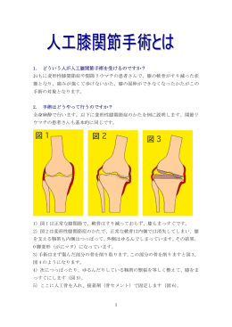 1 1. どういう人が人工膝関節手術を受けるのですか
