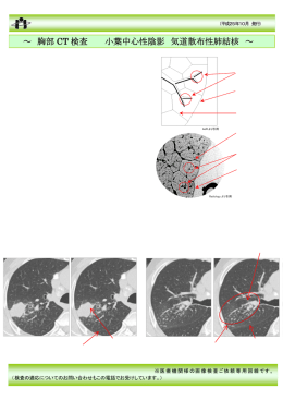 胸部CT検査 小葉中心性陰影 気道散布性肺結核