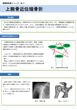 上腕骨近位端骨折(PDF