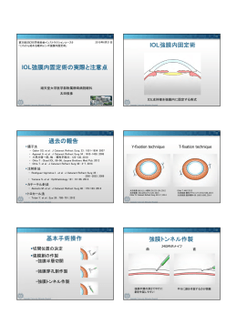 IOL強膜内固定術の実際と注意点 IOL強膜内固定術