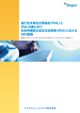 進行性多巣性白質脳症（PML）と PML治療に伴う 免疫再構築炎症反応
