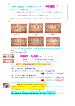 唇側矯正 20 万円 簡単に前歯だけ、早く矯正したい方に、プチ矯正 ！