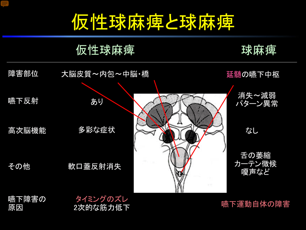 偽球麻痺と球麻痺の原因は何ですか?