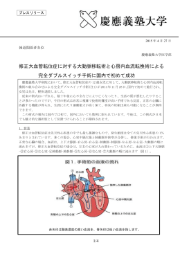 修正大血管転位症に対する大動脈移転術と心房内血流転換術による