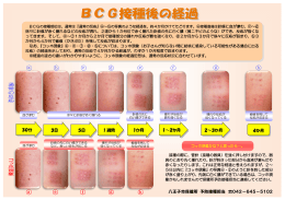 BCG接種後の経過（PDFファイル 328.2KB）