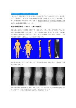 変形性膝関節症（日本人に多い内側型）