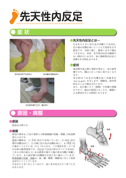 先天性内反足 - 日本足の外科学会