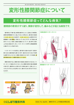 変形性膝関節症について [PDF:561KB]