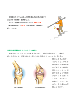 変形性関節症（膝・股関節）に対する人工関節置換術