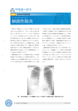 細菌性肺炎 - 日本呼吸器学会