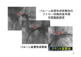 バルーン血管形成術無効の ファロー四徴術後早期 左肺動脈狭窄