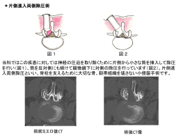 腰椎顕微鏡下片側進入両側除圧術 （腰部脊柱管狭窄症など）