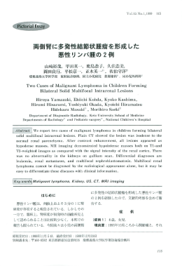 両側腎に多発性結節状腫瘤を形成した悪性リンパ腫の2例