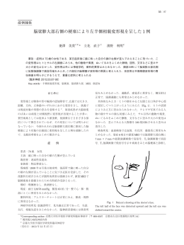 脳梁膨大部右側の 塞により左半側相貌変形視を呈した 1 例