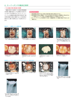 生活象牙質切削面の保護【PDF:1.4MB】