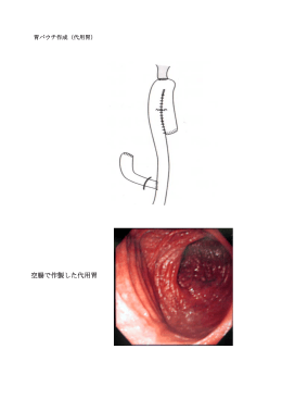 空腸で作製した代用胃