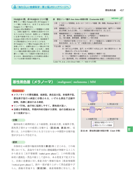 悪性黒色腫（メラノーマ） （malignant）melanoma；MM