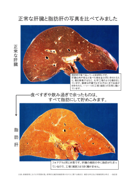 正常な肝臓と脂肪肝の写真を比べてみました