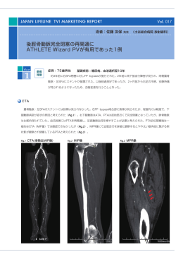 後脛骨動脈完全閉塞の再開通に ATHLETE Wizard