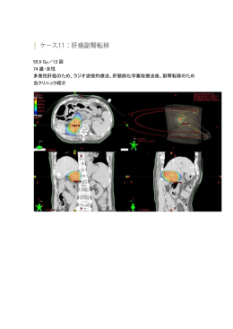 55.9 Gy／13 回 74 歳・女性 多発性肝癌のため、ラジオ波焼灼療法、肝