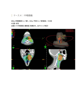 60Gy（同側頸部リンパ節）、54Gy（予防リンパ節領域）／30 回 45 歳