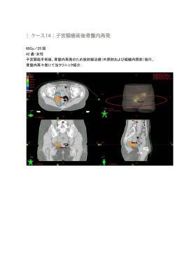 60Gy／25 回 42 歳・女性 子宮頸癌手術後、骨盤内再発のため放射線