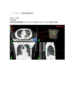 60,50Gy／20 回 63 歳・男性 食道癌多発性胸膜転移、セカンド
