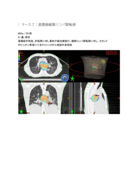 60Gy／20 回 61 歳・男性 直腸癌手術後、肝転移に対し重粒子線治療