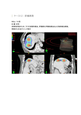 50Gy／10 回 82 歳・女性 多発性肝癌のため、ラジオ波焼灼療法、肝