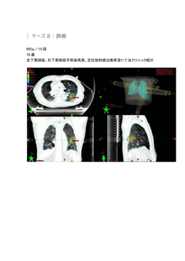 60Gy／10 回 78 歳 左下葉肺癌、右下葉肺癌手術後再発、定位放射線