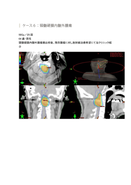 50Gy／25 回 64 歳・男性 頸髄硬膜内髄外腫瘍摘出術後、残存腫瘍に