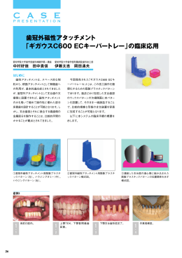 歯冠外磁性アタッチメント 「ギガウスC600 ECキーパートレー」の臨床応用